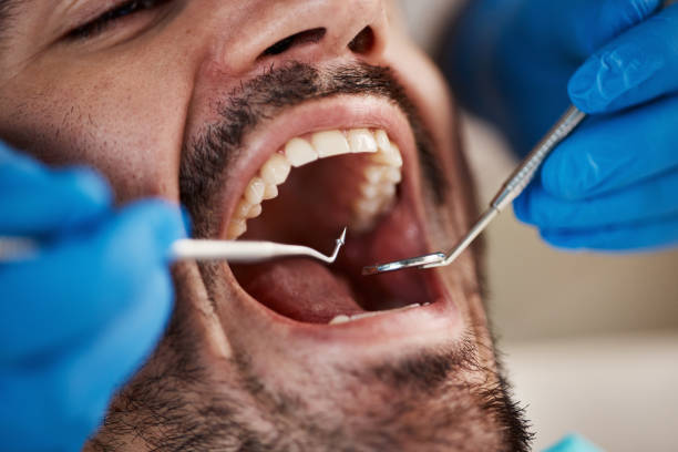 Best Emergency Dental Care for Broken or Chipped Teeth in Central Falls, RI